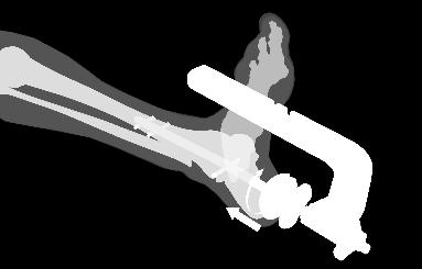 Continue turning the Apposition Handle to apply talocalcaneal apposition/compression (Fig. 26).