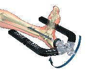 Insert the Tissue Protection Sleeve, Long, together with the Drill Sleeve, Long, and the Trocar, Long, into the Calcaneus hole of the Target Arm by pressing the Safety Clip.