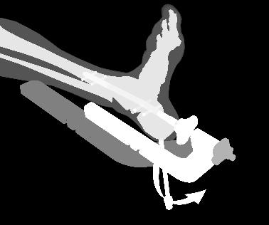 Step 3: Guided Locking of the Proximal Screws Guided Locking of the Proximal Screws must be performed with the Target Arm locked in the Medial Locking position (Fig. 32).