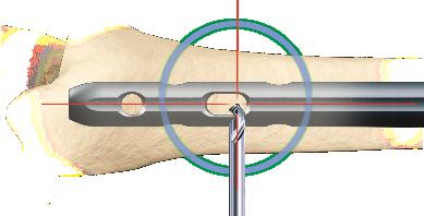 The critical step with any freehand locking technique, proximal or distal, is to visualize a perfectly round locking hole or perfectly oblong locking hole with the C-Arm. Hold the center-tipped Ø4.