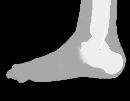 Care should be taken to assure neutral alignment of the knee and ankle.