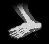 lateral) and take an axial heel view to align it with the longitudinal axis of the calcaneus (Fig. 6). Mark this line with a pen on the skin.
