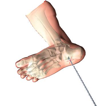 Entry Point The entry point is made under lateral and axial heel fluoroscopy control (Fig. 8) by using one of the following options: A center-tipped Drill Ø4.2 340mm (1806-4260S).