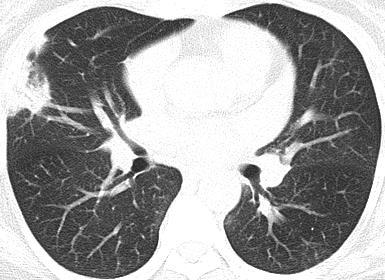 organizing pneumonia Often confused with constrictive bronchiolitis