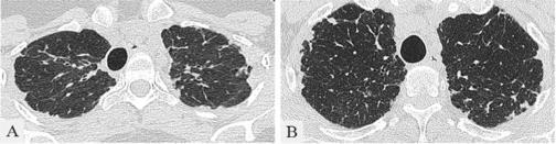 Pleuroparenchymal Fibroelastosis High mortality 40% Upper lung predominant Disease progression 60% Collagen vascular