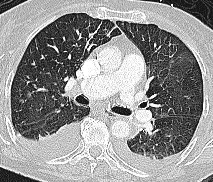 (UIP): Idiopathic Pulmonary Fibrosis (IPF) is description of clinical entity associated with morphologic pattern of UIP Poor prognosis CT