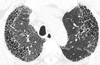 Extensive interstitial fibrosis