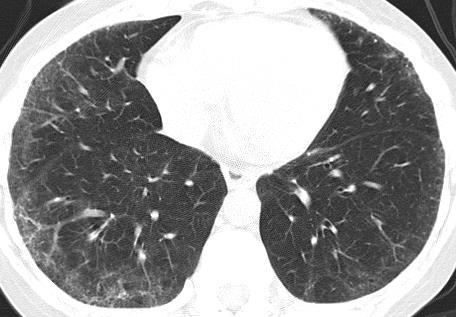 male with fibrotic NSIP