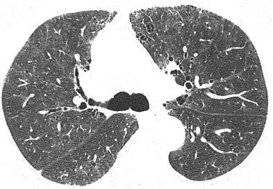 RB-ILD: Features 1 RB-ILD: Features 2 Histologic respiratory bronchiolitis is in 100% of