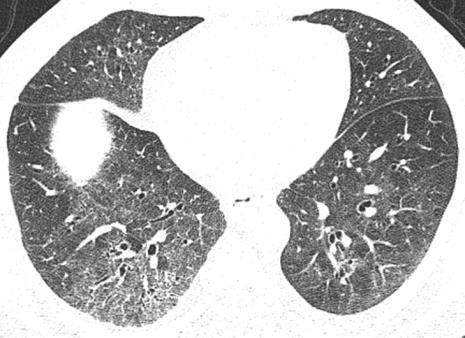 similar to hypersensitivity pneumonitis Centrilobular ground glass nodularity Upper and mid-lung