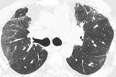 They considered to call alveolar macrophage pneumonia.