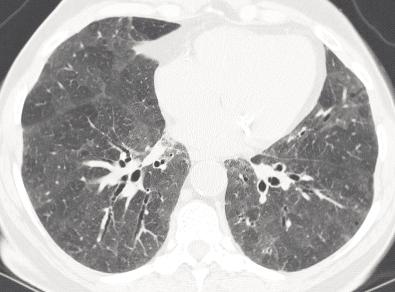 Idiopathic interstitial pneumonias Figure 1 - High-resolution chest CT of a 75-year-old woman, nonsmoker, whose surgical lung biopsy showed a usual interstitial pneumonia (UIP) pattern.