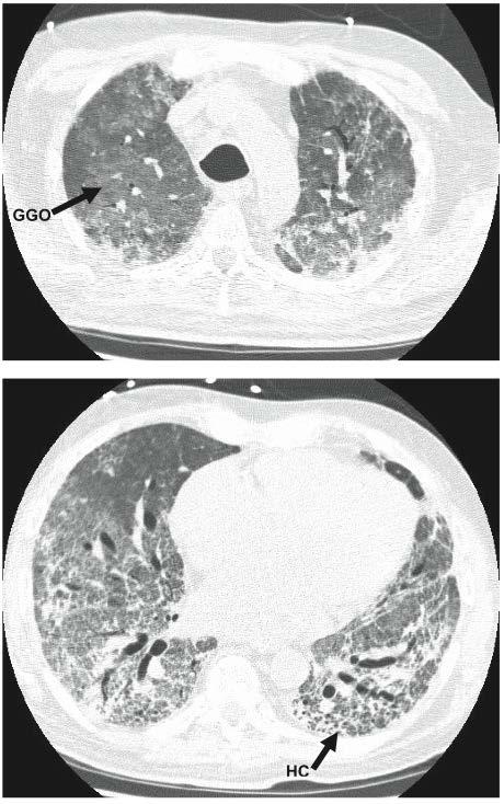 Idiopathic Pulmonary Fibrosis Acute Exacerbation Acute or sub-acute onset of worsening dyspnea Not explained by other causes (infection, heart