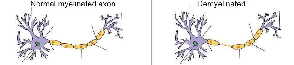 2.4 I mpacts of De my e lination to Neuro n Figure 3. Two neuronal cells. Normal myelination (left); Partially demyelinated (right).