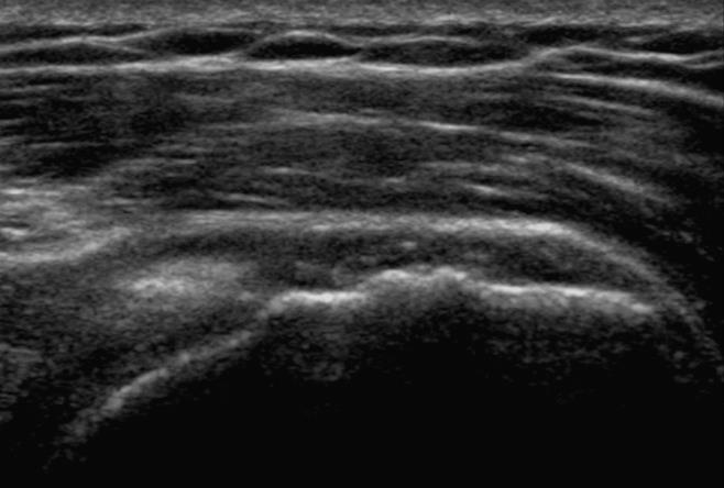 Tear Musculoskeletal Ultrasound Focal Tendon Abnormality Non visualization Focal hypoechoic tendon