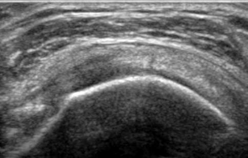 Focal Tendon Abnormality Partial