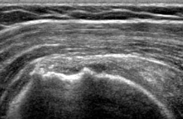 Focal Tendon Abnormality