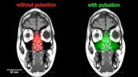 - 5 - respectively, are superimposed on the test subject s MRI images (Fig. 5). The image on the left shows the areas (in red) that are ventilated during inhalation without pulsating airflow.