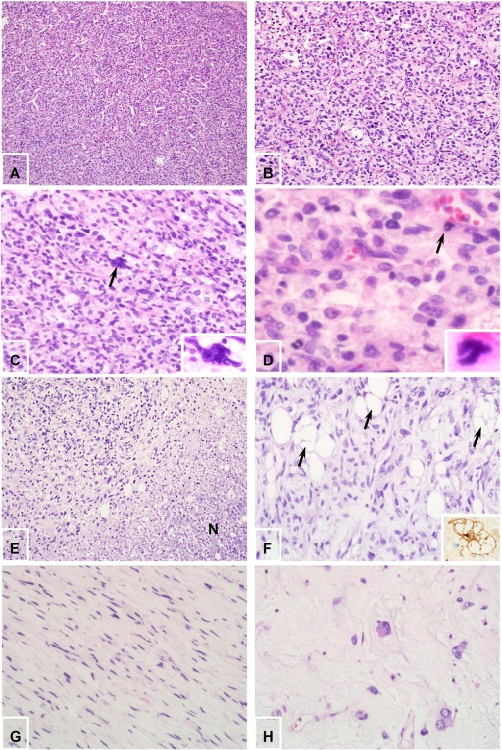 Wang et al. Diagnostic Pathology 2014, 9:13 Page 4 of 7 Figure 3 Microscopic features.