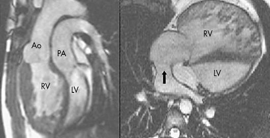The Systemic Right Ventricle D TGA: The systemic RV is dilated and severely