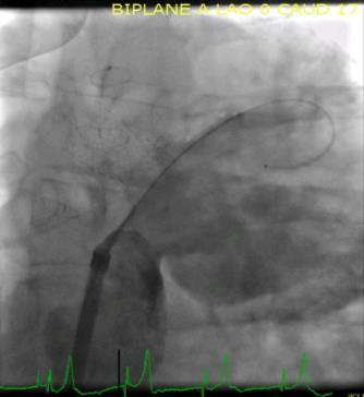 37M D-TGA s/p Mustard admitted with