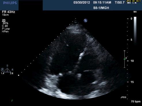 Indications for PVR in patients with repaired TOF RV size and function (cardiac MRI): RVEDVI > 150ml/m2 RVESVI > 80ml/m2 RVEF < 47% LV systolic dysfunction: LVEF < 55% Large RVOT aneurysm QRS