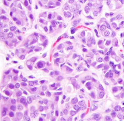 Classic LCIS: loss of cell to