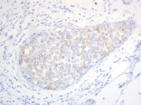 E-cad/catenin complex (abnormal staining pattern