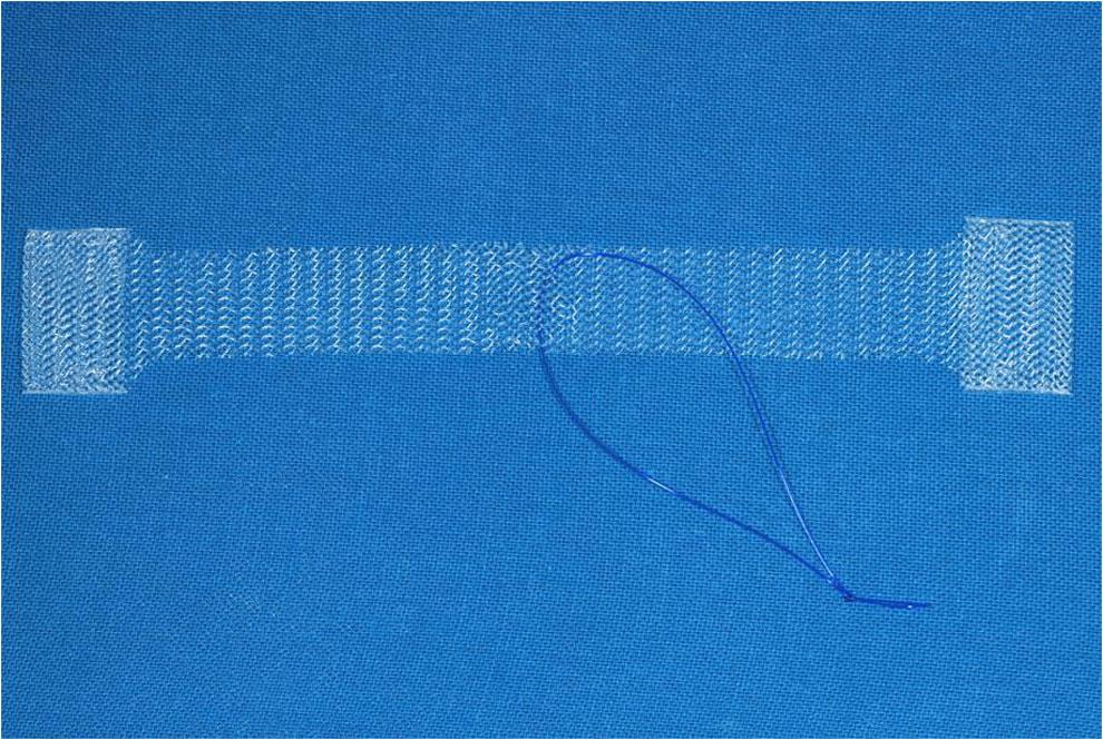 Int Urogynecol J produces a similar suburethral hammock to standard midurethral slings, avoiding both retropubic and groin trajectories, thus theoretically maintaining high cure rates [15].