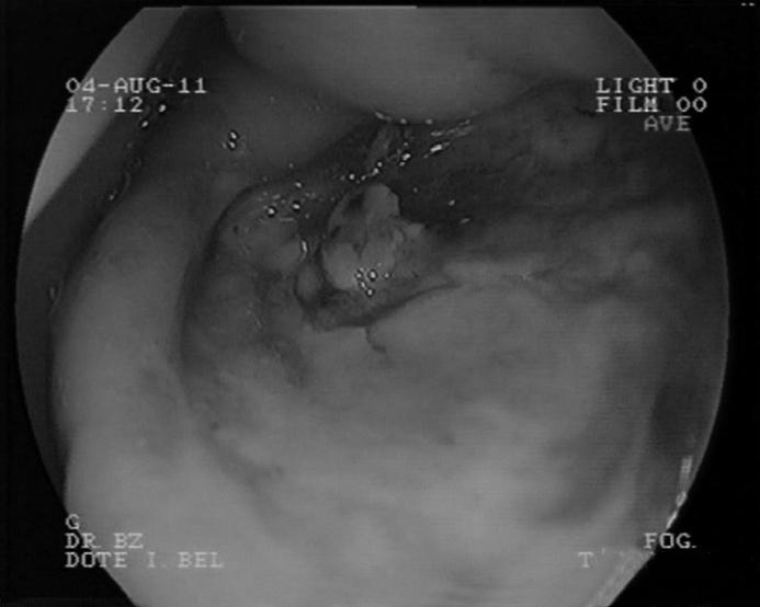 ulcer with biopsy, duodenal ulcer with alarm symptoms and