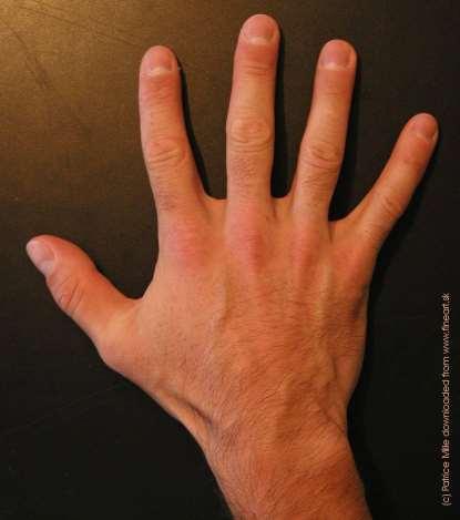 The Hand Dorsal aspect 2 3