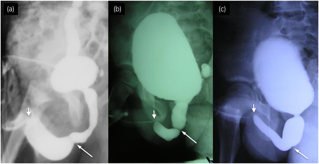 AM KAJBAFZADEH ET AL. Table 2 Clinical presentation, radiological ﬁndings and treatment methods in six patients with concomitant AUV PUV Case no.