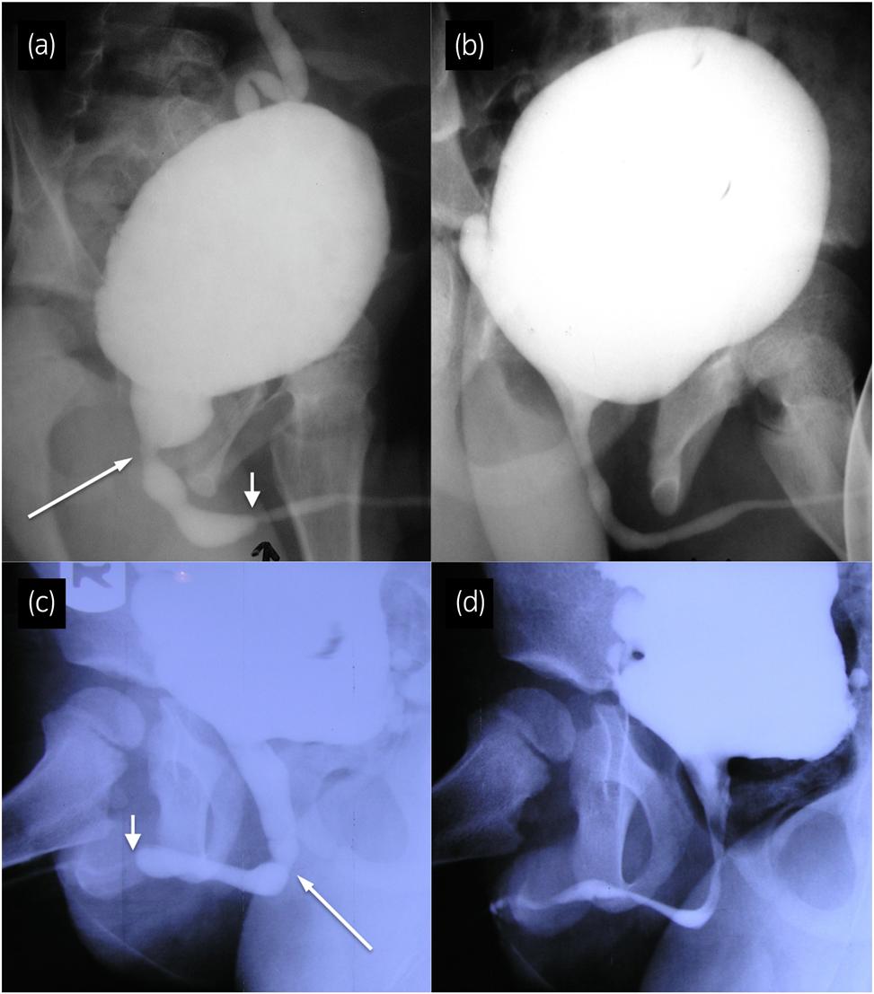Concomitant anterior and posterior urethral valves Fig. 2 (a,c) Preoperative voiding cystourethrography showing anterior (short arrows) and posterior (long arrows) urethral valves.