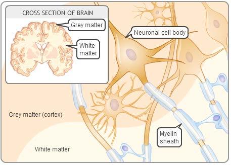 Pathophysiology Catecholamines Dopamine, norepinephrine Mediate CNS functions: Motor control, Cognition, Emotion, Memory processing White Matter: axons and myelin sheath