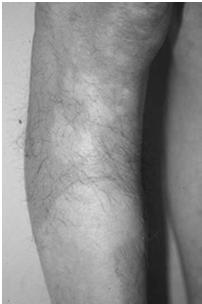 Primary Lesions Patch - larger than 1 cm,  Examples: vitiligo, senile