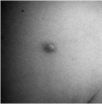 Primary Lesions Papule - up to 1 cm in size, circumscribed, elevated,