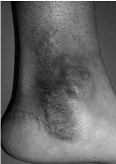 Examples: elevated nevi, warts, lichen planus A wheal is a type of papule