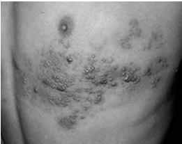 Examples: tumor stage of mycosis fungoids, larger epitheliomas Primary