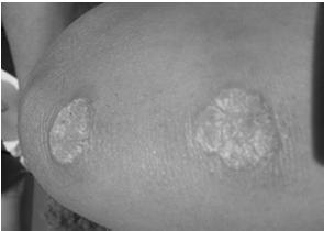 Primary Lesions Pustule - vary in size, circumscribed elevations of the