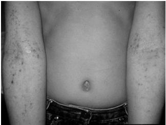 Examples: acne, impetigo Secondary Lesions Scales - shedding, dead