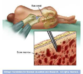 Assessment of bone marrow
