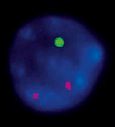 signal: deletion of a chromosome arm Normal MYC signal