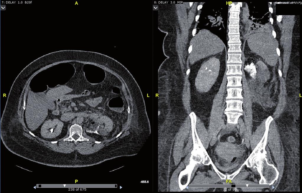 ibju Urine leak in minimally invasive partial nephrectomy Figure 1 - Axial and coronal CT images documenting left urine leak after surgery.