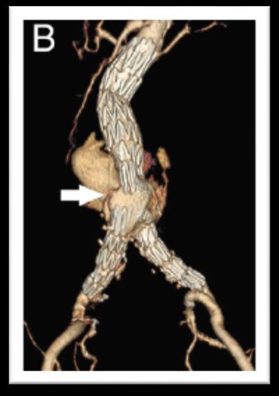 in larger aneurysms Even in presence of large thrombus burden Neck angulation and AAA angulation will