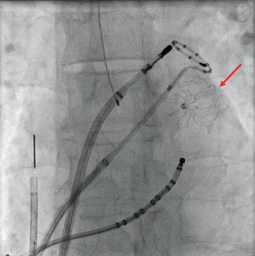 There is a rational for combined LAA closure and AF ablation Can a combined procedure of PVI