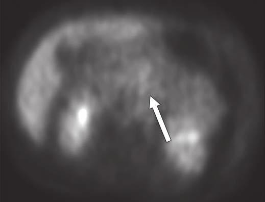 chemotherapy shows residual tumor mass (arrows), but corresponding PET image (D) shows lack of FDG uptake in residual