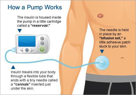 Insulin Pumps A computerized device that delivers a continuous pulse of insulin.