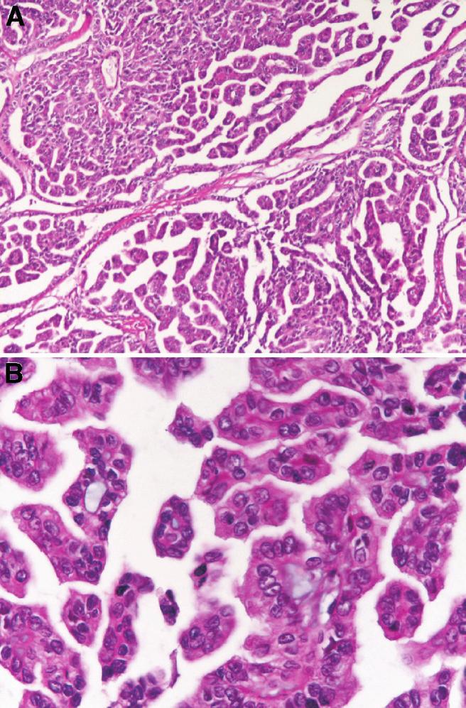 [15] showed that, using in situ hybridization, patients also with trisomy 7, trisomy 17, and with a normal chromosome 3 presented a solid variant of papillary carcinoma (glomeruloid variant).