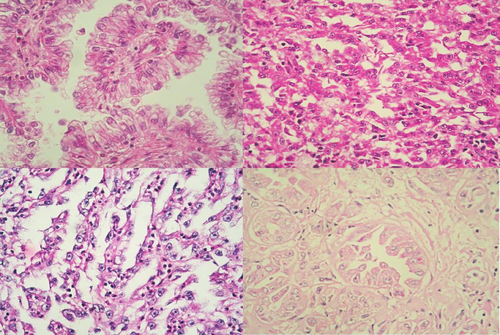 V. Mancini et al. / Urologic Oncology: Seminars and Original Investigations 26 (2008) 225 238 231 Fig. 5. Malignant tumors.