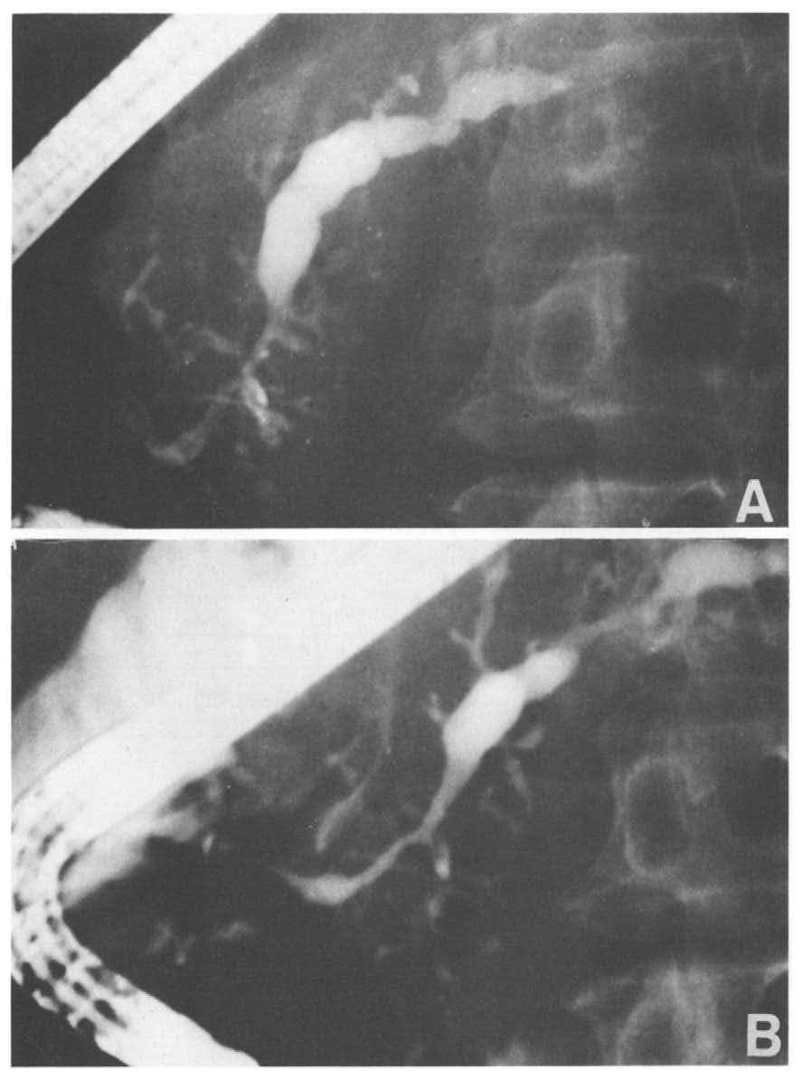 Stenosis in the head spread widely and irregular stenosis developed in the dilated main duct at the body of the pancreas. The changes of branch ducts are progressive.